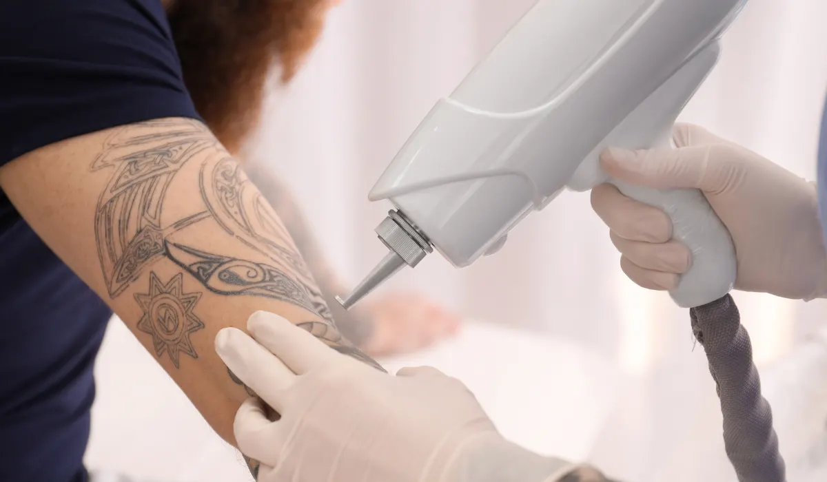 Sessão de remoção de tatuagem a laser no braço de um paciente